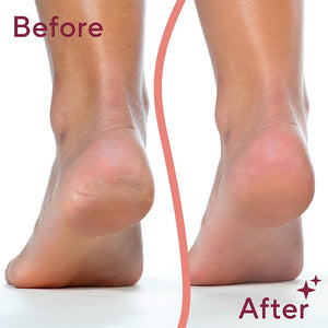 Dual Head Electric Feet Callus Remover